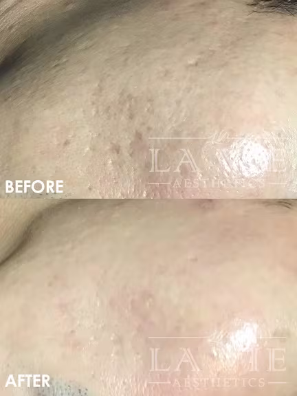 ="MRF MRF (RF Microneedling) Promotion